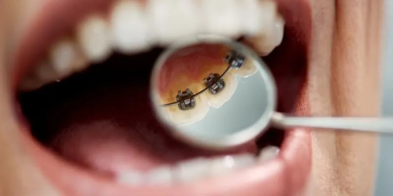 Các loại niềng răng phổ biến